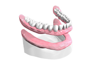 appareil-resine-complet